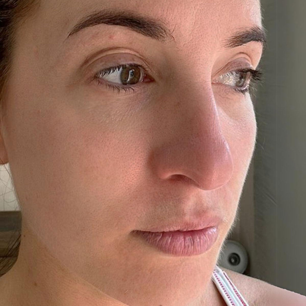 Before and after photo of real 35-year-old user showing visible improvements in skin texture, glow, and fine lines after using CHOUCHOU TOKYO beauty device.